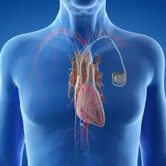 Anatomical illustration showing a human heart with a rozrusznik serca implanted.