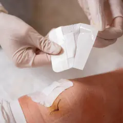 Ręce w rękawiczkach przygotowują opatrunek na ranę pooperacyjną, na której widać szwy. Prawdopodobnie użyta zostanie chlorheksydyna do dezynfekcji.