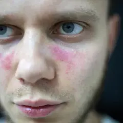 Zbliżenie na twarz mężczyzny z zaczerwienieniem na policzkach i pod oczami.