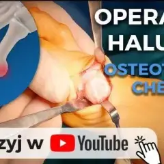 Czy haluksy odrastają? Odkryj prawdę o nawrotach po operacji