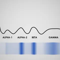 Wykres proteinogramu z frakcjami: albuminy, alfa-1, alfa-2, beta i gamma.