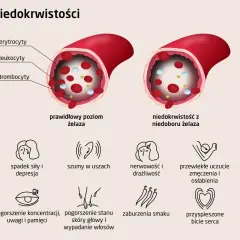 Porównanie prawidłowego poziomu żelaza z niedoborem. Niedobór żelaza prowadzi do anemii, objawiającej się m.in. bladością skóry, zmęczeniem, bólami głowy.