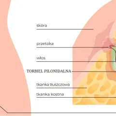 Ilustracja przedstawia przekrój skóry z widoczną przetoką i włosem tworzącym torbiel pilonidalną.