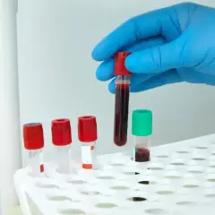 Ręka w niebieskiej rękawiczce trzyma probówkę z krwią do analizy APTT.