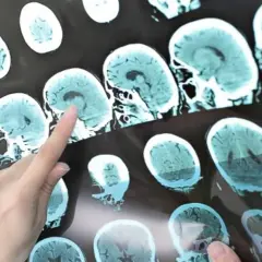 Dłoń wskazuje na obraz mózgu, analizując wyniki, które mogą sugerować domowy test na stwardnienie rozsiane.