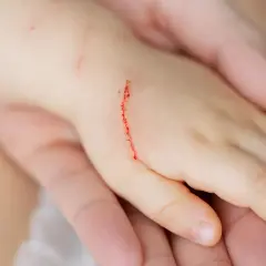 Dziecięca dłoń z zadrapaniem, być może od kota. Rana jest czerwona i lekko krwawi.