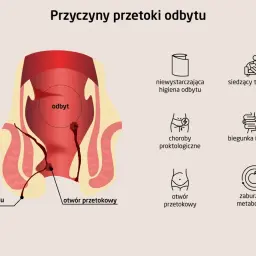 Ilustracja przedstawia anatomię odbytu z widoczną przetoką odbytu, wskazując na jej przyczyny, takie jak choroby proktologiczne czy zaburzenia metabolizmu.
