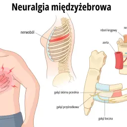 Ilustracja przedstawia mężczyznę z bólem w klatce piersiowej, wskazującym na **neuralgię międzyżebrową**. Pokazuje też szczegółowo unerwienie żeber.