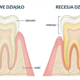 Porównanie zdrowego dziąsła z recesją dziąsła, która odsłania korzeń zęba. Zapalenie dziąseł może prowadzić do cofania się dziąseł.