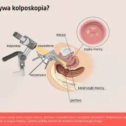 Kolposkopia pozwala wykryć zmiany przedrakowe, takie jak dysplazja szyjki macicy, dzięki badaniu szyjki macicy.