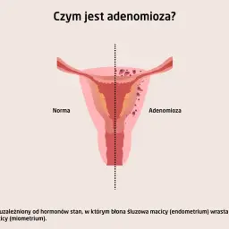 Ilustracja porównuje zdrową macicę z macicą dotkniętą **adenomiozą**, gdzie tkanka endometrium wrasta w mięsień macicy.