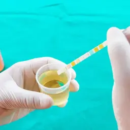 Rękawiczka medyczna zanurza pasek testowy w próbce moczu, badając obecność nabłonków płaskich.