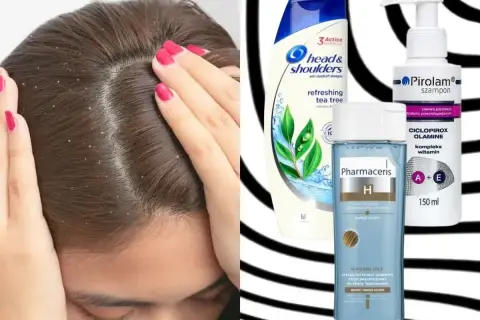 Kobieta z łupieżem na głowie. Obok szampony Head & Shoulders, Pirolam i Pharmaceris – co na łupież.