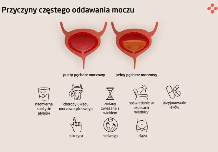Ilustracja pokazuje pęcherz pusty i pełny, wyjaśniając przyczyny częstego oddawania moczu: nadmierne picie, choroby, wiek, naświetlanie, leki, cukrzyca, nadwaga, ciąża.