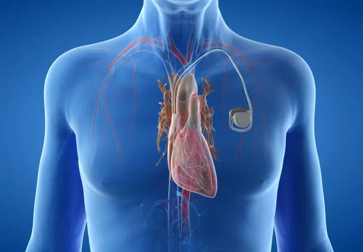 Anatomical illustration showing a human heart with a rozrusznik serca implanted.