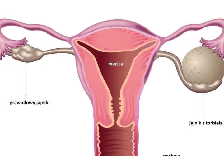 Anatomia kobieca: macica, jajowody, jajnik prawidłowy i jajnik z torbielą.