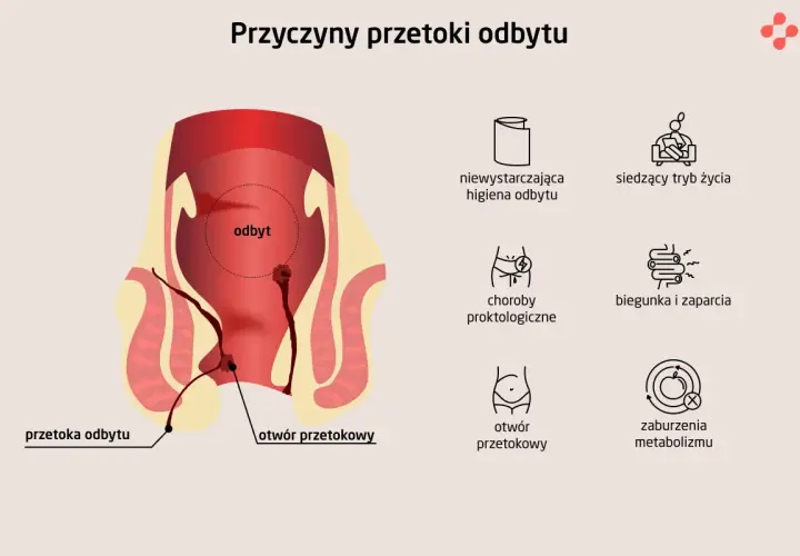 Ilustracja przedstawia anatomię odbytu z widoczną przetoką odbytu, wskazując na jej przyczyny, takie jak choroby proktologiczne czy zaburzenia metabolizmu.