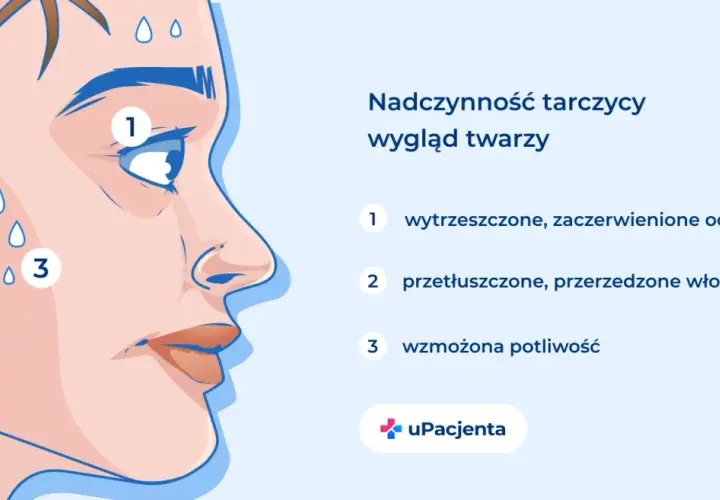 Nadczynność tarczycy objawy: wytrzeszczone oczy (1), przetłuszczone włosy (2) i wzmożona potliwość (3) na twarzy.