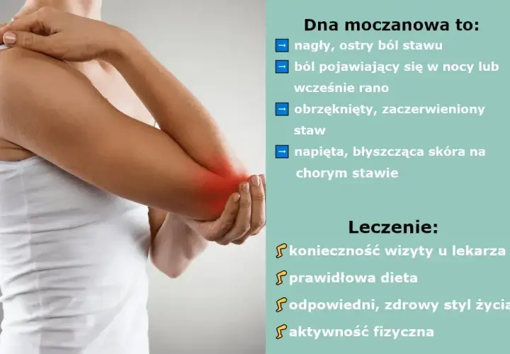 Ból stawu łokciowego z zaczerwienieniem. Leczenie dny moczanowej, np. milurit 300, wymaga wizyty u lekarza, diety i aktywności fizycznej.