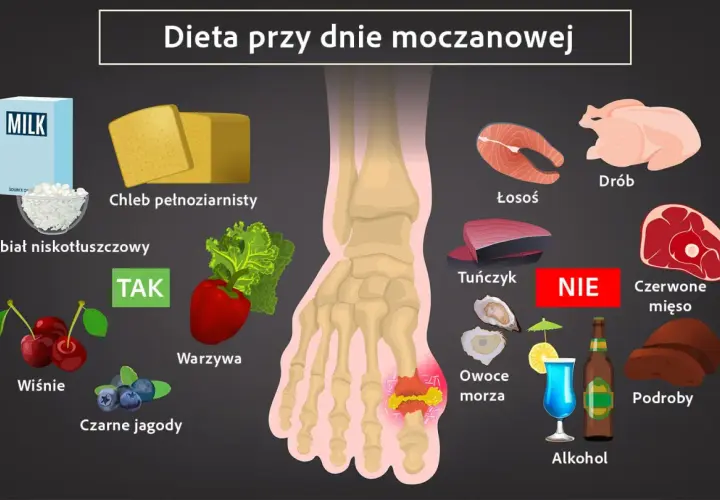 Dieta przy dnie moczanowej: TAK - nabiał, chleb, warzywa, wiśnie, jagody. NIE - drób, łosoś, tuńczyk, czerwone mięso, podroby, owoce morza, alkohol.