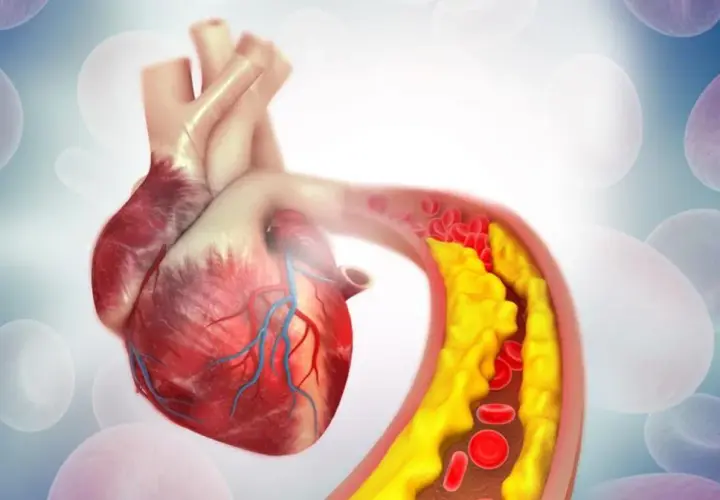 Serce i tętnica z cholesterolem. Wysoki cholesterol nie HDL może prowadzić do zwężenia naczyń.