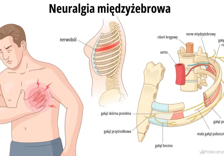Ilustracja przedstawia mężczyznę z bólem w klatce piersiowej, wskazującym na **neuralgię międzyżebrową**. Pokazuje też szczegółowo unerwienie żeber.