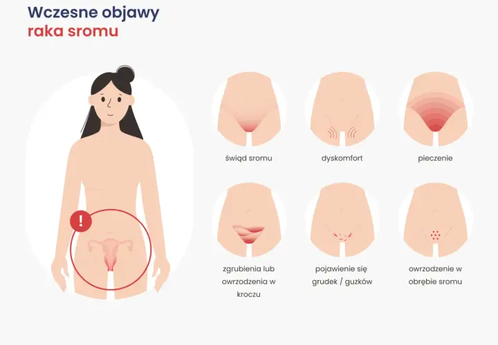 Ilustracja pokazuje wczesne objawy raka sromu: świąd, pieczenie, dyskomfort, owrzodzenia i grudki.