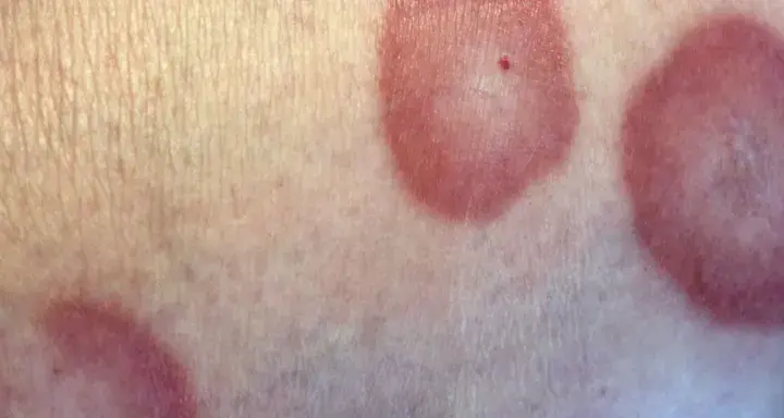 Choroba róża na nodze objawy – jak rozpoznać i uniknąć powikłań
