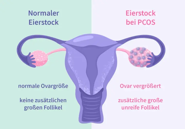 Porównanie jajnika: normalny vs. przy PCOS. Obraz pokazuje powiększony jajnik z licznymi niedojrzałymi pęcherzykami, co jest jednym z objawów PCOS.