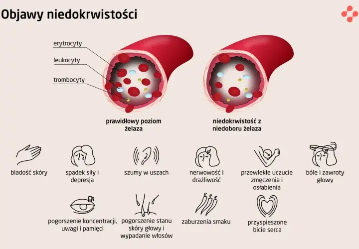 Porównanie prawidłowego poziomu żelaza z niedoborem. Niedobór żelaza prowadzi do anemii, objawiającej się m.in. bladością skóry, zmęczeniem, bólami głowy.