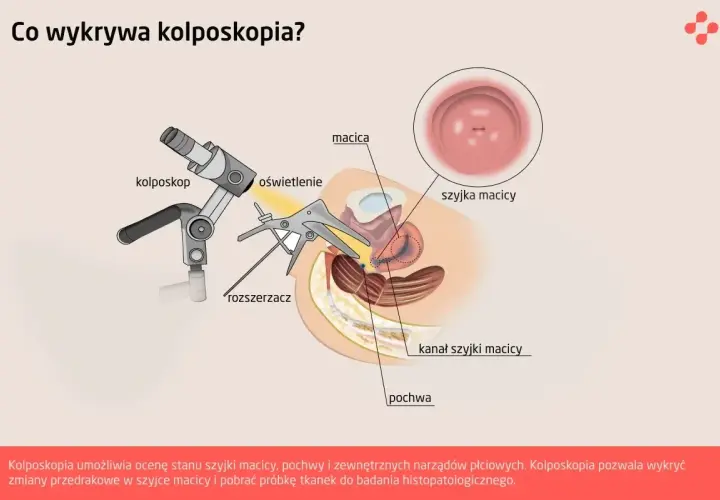 Kolposkopia pozwala wykryć zmiany przedrakowe, takie jak dysplazja szyjki macicy, dzięki badaniu szyjki macicy.