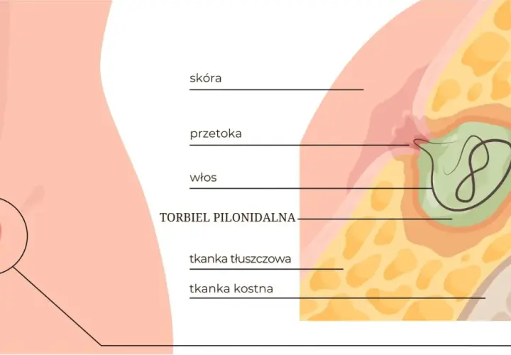 Ilustracja przedstawia przekrój skóry z widoczną przetoką i włosem tworzącym torbiel pilonidalną.