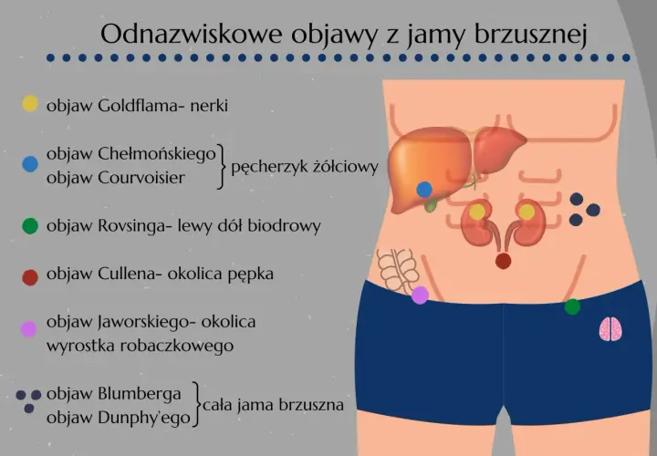 Objaw Jaworskiego zaznaczony fioletową kropką w okolicy wyrostka robaczkowego, ilustruje lokalizację bólu przy zapaleniu wyrostka.