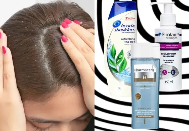 Kobieta z łupieżem na głowie. Obok szampony Head & Shoulders, Pirolam i Pharmaceris – co na łupież.