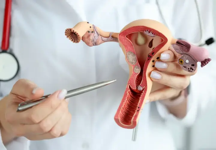 Model narządu rodnego kobiety z widocznymi zmianami, które mogą sugerować raka endometrium. Lekarz wskazuje na nie długopisem.