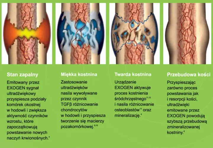Ilustracje pokazują etapy gojenia kości: stan zapalny, miękką i twardą kostninę, a na końcu przebudowę kości. Proces ten, dzięki EXOGEN, przyspiesza tworzenie nowej tkanki kostnej, redukując problem **łamliwości kości**.