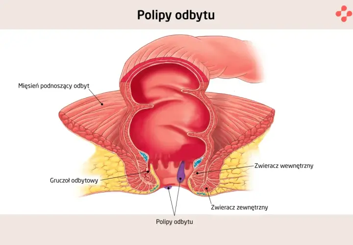 Anatomia odbytu z widocznymi polipami. Ilustracja pokazuje mięsień dźwigacz odbytu, gruczoły odbytu, zwieracze wewnętrzny i zewnętrzny oraz polipy odbytu.