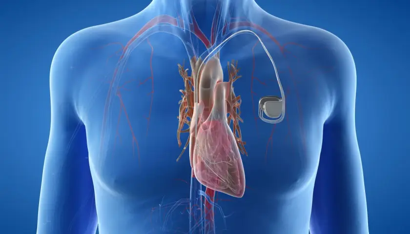 Anatomical illustration showing a human heart with a rozrusznik serca implanted.
