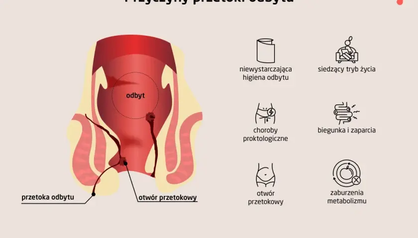 Ilustracja przedstawia anatomię odbytu z widoczną przetoką odbytu, wskazując na jej przyczyny, takie jak choroby proktologiczne czy zaburzenia metabolizmu.