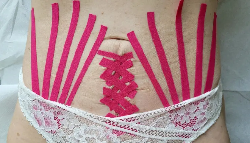 Brzuch z różowymi taśmami kinezjotaping w kształcie wachlarza i gorsetu.