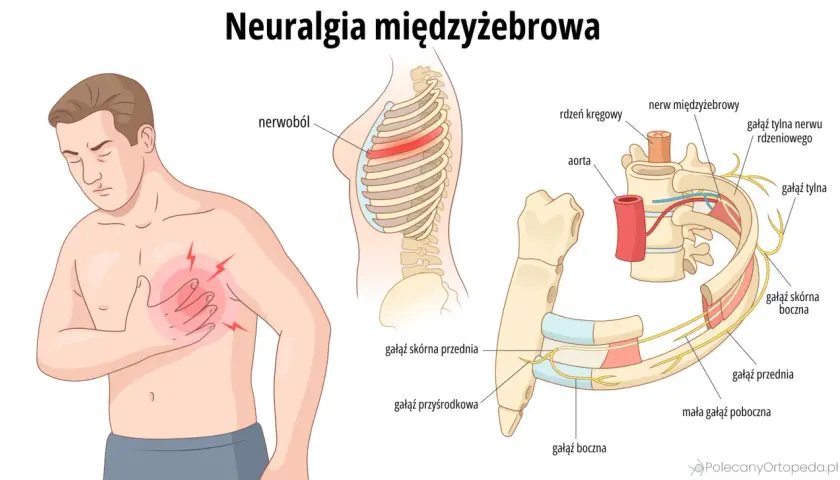 Ilustracja przedstawia mężczyznę z bólem w klatce piersiowej, wskazującym na **neuralgię międzyżebrową**. Pokazuje też szczegółowo unerwienie żeber.