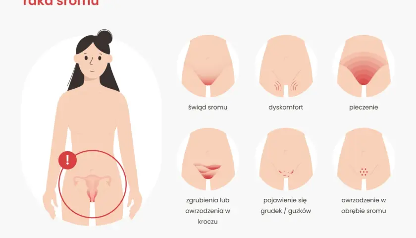 Ilustracja pokazuje wczesne objawy raka sromu: świąd, pieczenie, dyskomfort, owrzodzenia i grudki.