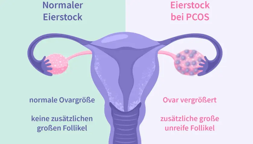 Porównanie jajnika: normalny vs. przy PCOS. Obraz pokazuje powiększony jajnik z licznymi niedojrzałymi pęcherzykami, co jest jednym z objawów PCOS.