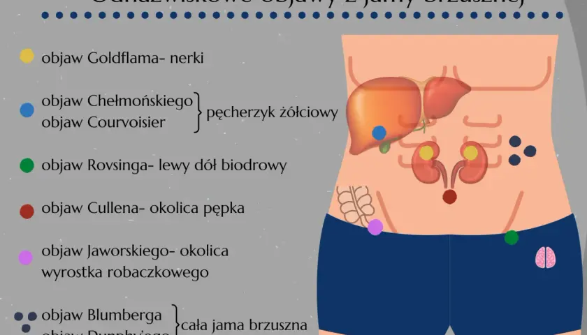 Objaw Jaworskiego zaznaczony fioletową kropką w okolicy wyrostka robaczkowego, ilustruje lokalizację bólu przy zapaleniu wyrostka.