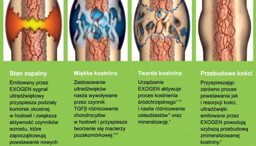 Ilustracje pokazują etapy gojenia kości: stan zapalny, miękką i twardą kostninę, a na końcu przebudowę kości. Proces ten, dzięki EXOGEN, przyspiesza tworzenie nowej tkanki kostnej, redukując problem **łamliwości kości**.