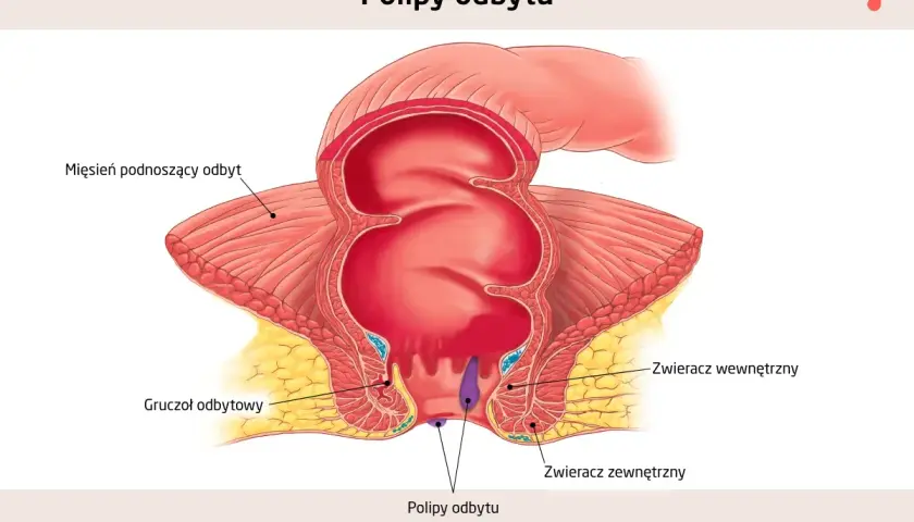 Anatomia odbytu z widocznymi polipami. Ilustracja pokazuje mięsień dźwigacz odbytu, gruczoły odbytu, zwieracze wewnętrzny i zewnętrzny oraz polipy odbytu.