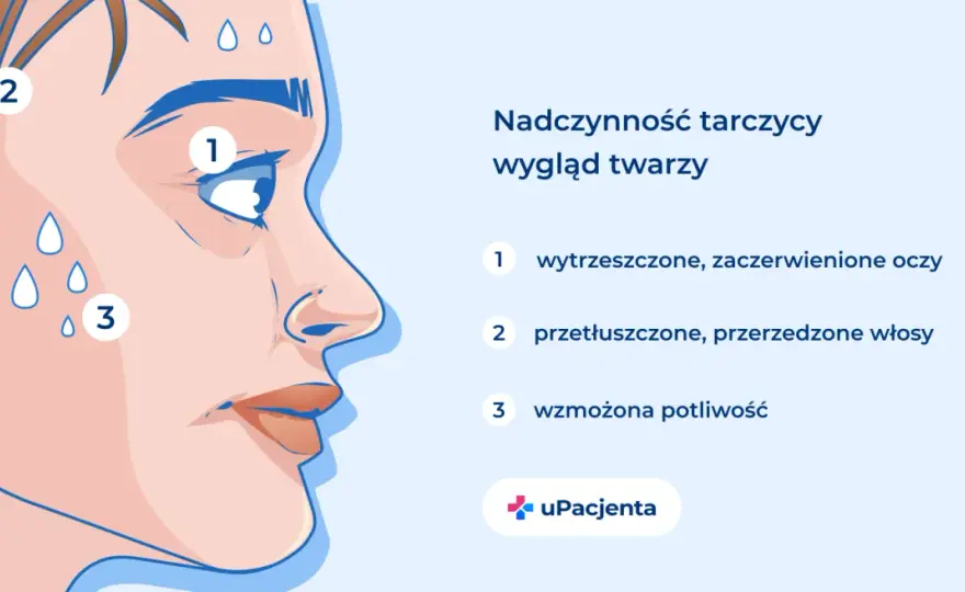 Nadczynność tarczycy - objawy. Czy to stres, czy choroba?