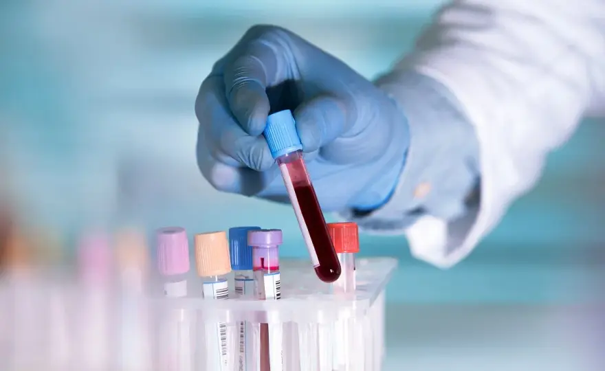 Lipoproteina(a) - Kiedy badać, jak czytać i co dalej?