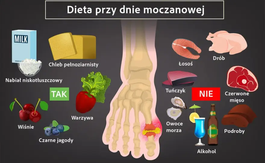 Milurit - na kwas moczowy i dnę. Kiedy stosować, na co uważać?