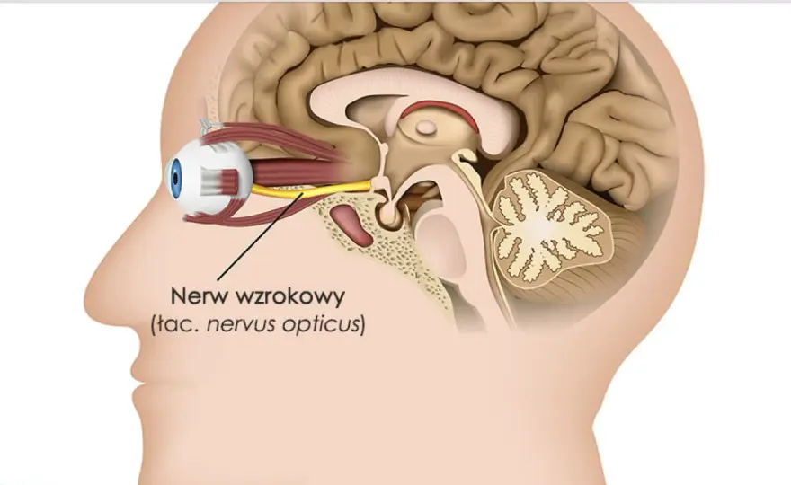 Zapalenie nerwu wzrokowego - objawy, z czym je pomylić i kiedy reagować
